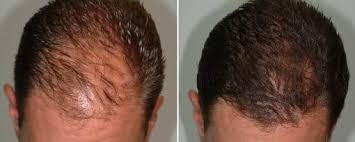 Anti-Hair Fall Hair Oil